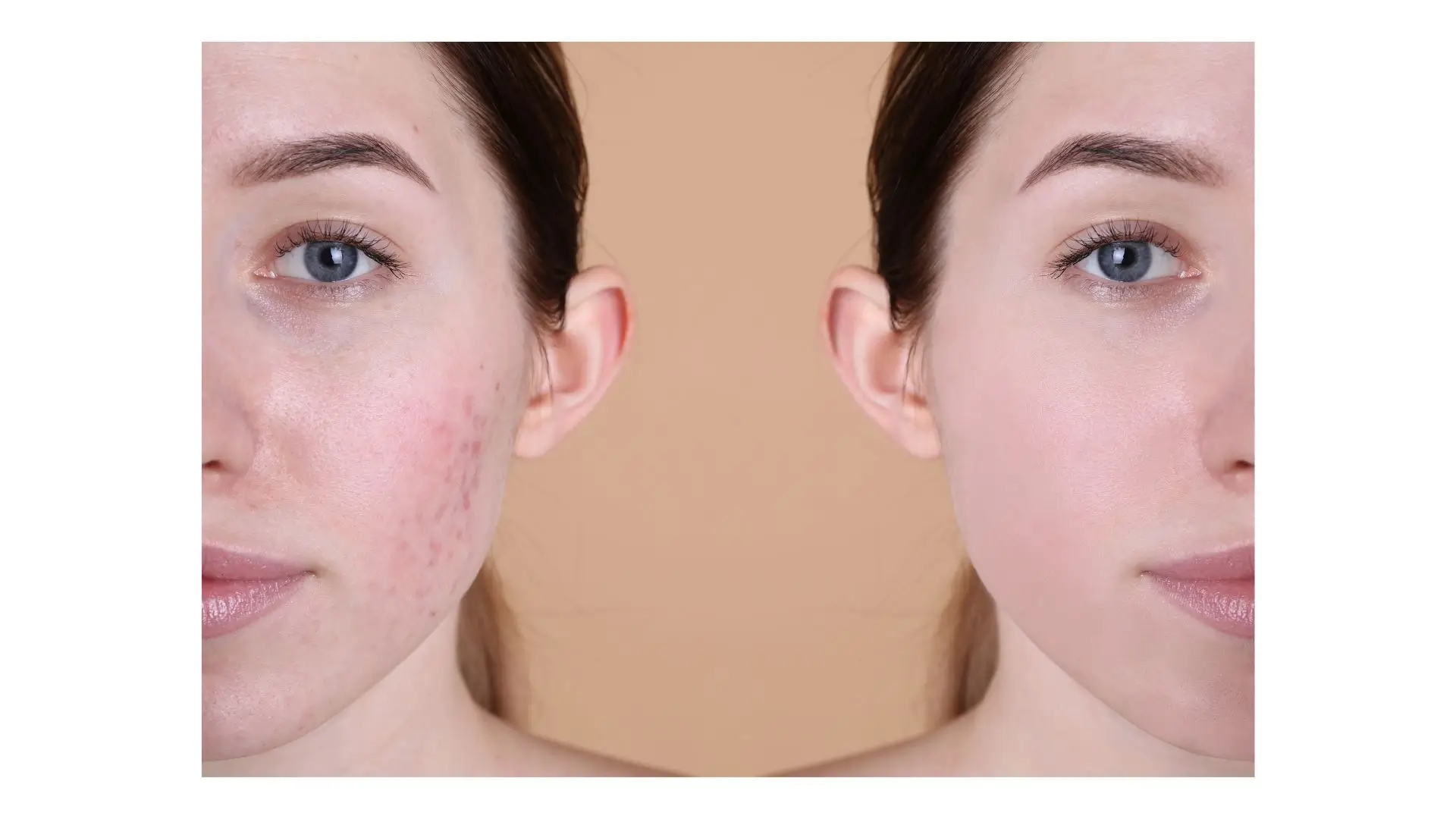 Two women with visible acne on their faces, showcasing diverse skin types and expressions of confidence.